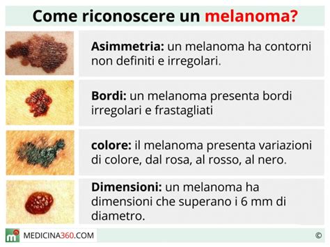 come riconoscere il melanoma